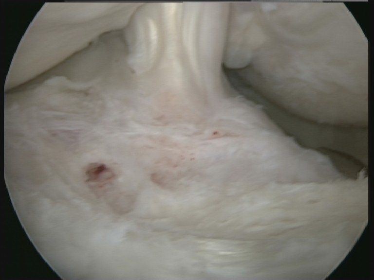 Jumper's knee ice or heat