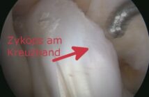 osteopathie knie knorpelschaden