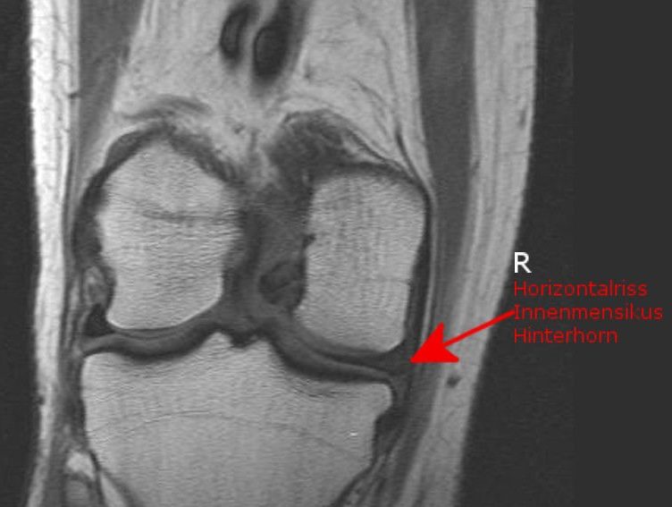 Meniskusriss mit Kreuzbandriss Knie Marathon