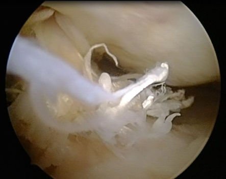 Arthrofibrose im Knie nach Kreuzbandriss OP