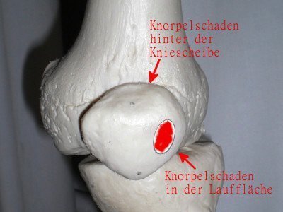 Knorpelschaden operieren - Abrasion Knorpelschaden operieren - Abrasion