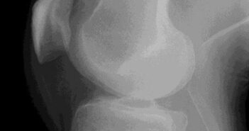 Arthrose oder Verschleiß im Knie operieren – wann sinnvoll? Verschleiß am Knie - Röntgen Arthrosezeichen