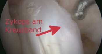15 Fehler, wenn nach Kreuzband-OP Komplikationen auftreten Zyklops nach Kreuzband-OP