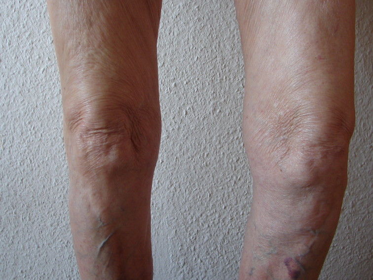 Das Arthroserisiko steigt Daran ändert auch eine KreuzbandOP nichts KnieOP & Reha