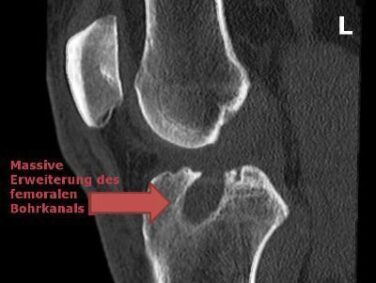 Zweiter Kreuzbandriss im gleichen Knie – Wiedereingriff in nur einer OP ...