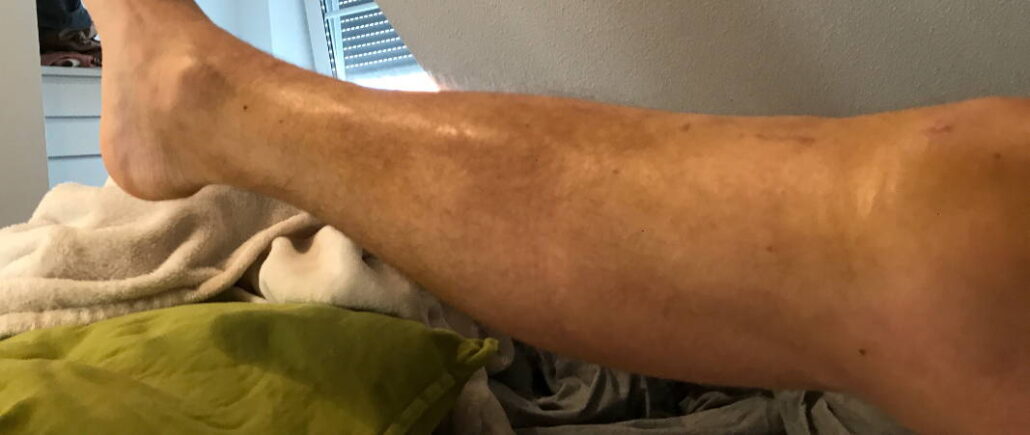 Bluterguss Im Knie Nach Op www.knie-marathon.de